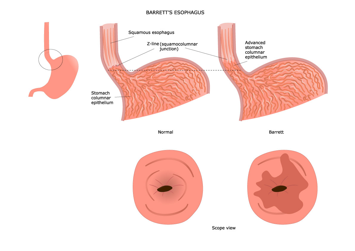 Z линия пищевода. Классификация пищевода Барретта эндоскопия. Пищевод Барретта эндоскопия.